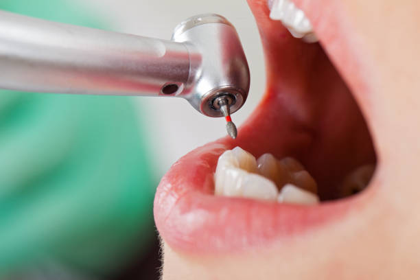 Best Emergency Dentist for Knocked-Out Tooth in Rancho Cumonga, CA